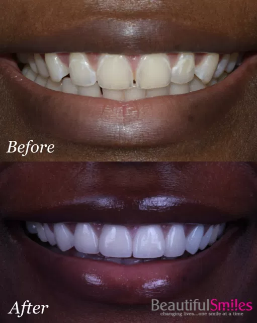 Smile transformation
